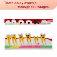 thumbnail image 3 of Dental Caries Developing Model, Dental Teeth Model for Dental Tooth Anatomy Study, 3 of 7