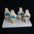 thumbnail image 1 of Anatomical Human Degenerative Knee Joint Disease Model Medical Skeleton Anatomy Teaching Resources, 1 of 1