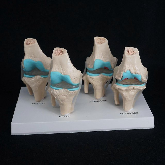 Anatomical Human Degenerative Knee Joint Disease Model Medical Skeleton Anatomy Teaching Resources