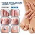 thumbnail image 3 of Nail Fungus Treatment,sumifun New Bright Nail Suit Series Gray Nail Care, 3 of 5