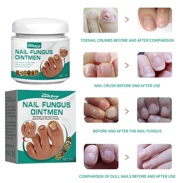 Gel para eliminar hongos en las uñas crema reparadora de uñas antiinfección pomada reparadora