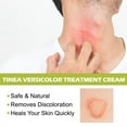 Tinea Versicolor Treatment Cream Body Antifungal Gel for Tinea