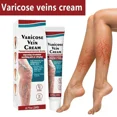 thumbnail image 4 of Crema para tratamiento de venas varicosas, angitis, piernas, alivio dilatado, Vasculitis, flebitis, pierna Araña, Varicosity, medicina para el cuidado de los pies, 4 of 5
