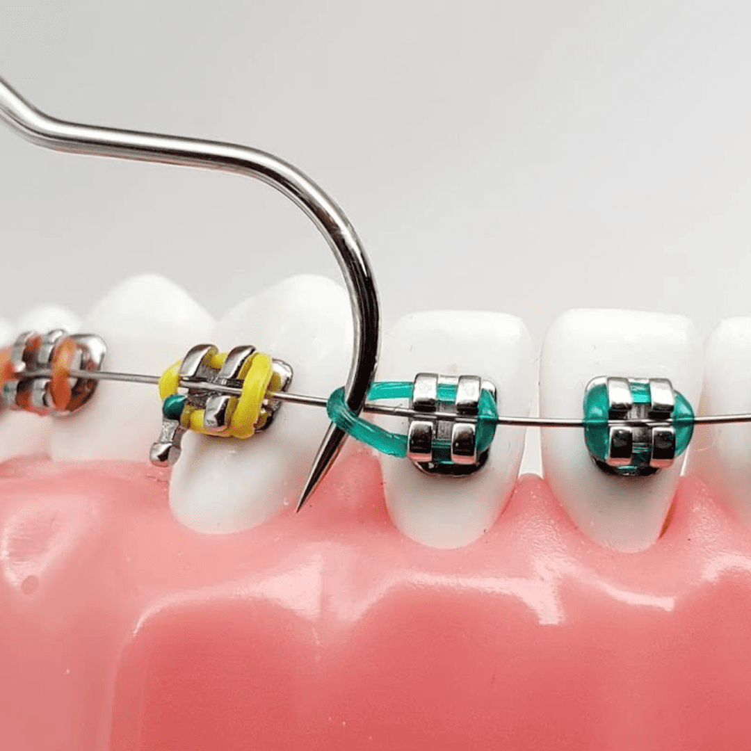 Buy Braces Ligature Ties Removal Color Changing Tool Probe by Artman