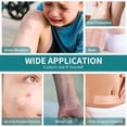 thumbnail image 4 of QARUN Hydrocolloid Roll for Wound Care,Pimple Patch Roll Tape Medical Grade Bandages for Acne,Blisters,Burn Self-Adhesive Ultra Absorbent Flexible Waterproof 2In Width Diy Size(2In*16Ft), 4 of 7