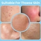 thumbnail image 5 of Almohadillas faciales exfoliantes de ácido salicílico Kestper, 70 unidades, 5 of 7
