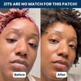 thumbnail image 3 of Parches para espinillas CLEAN SKIN CLUB Derma Dot Hydrocoloid Vegan, 3 of 7
