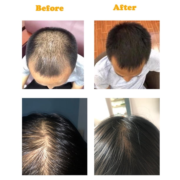 Aerosol Para El Crecimiento Del Cabello Suero para el cuidado del cabello de 20 ml, suero para el cabello de crecimiento rápido de jengibre eficaz, productos para el cuidado del cabello Ndcxsfigh Cuidado Belleza
