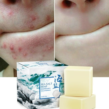 Sea Salt Soap Cleaner Removal Pimple Pores Acne Treatment Goat Milk Moisturizing Face Care (Best Pimple Care Soap)