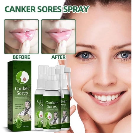 3Pcs Oral Ulcer Relief Spray, Professional Safe Canker Sore Spray???apid absorption For Oral Care For Men Women???ral Treatment for Sores