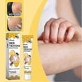 thumbnail image 2 of vitiligo skin care cream portable anti-itch treatment, 2 of 5