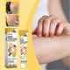 thumbnail image 2 of vitiligo skin care cream portable anti-itch treatment, 2 of 5