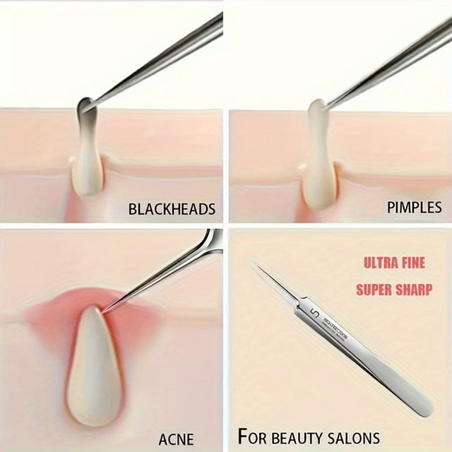 1/3 Pcs Pinces Professionnelles pour Enlever les Points Noirs du Visage, Kit de Suppression de l'Acné, Outil pour Faire Éclater les Boutons, Acier Inoxydable