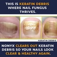 thumbnail image 5 of Nonyx Fungal Nail Clarifying Gel Clears Out Keratin Debris 4 oz, Pack of 4, 5 of 5
