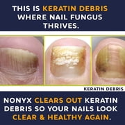 Nonyx Fungal Nail Clarifying Gel Clears Out Keratin Debris 4 oz, Pack of 4
