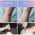 thumbnail image 4 of Class Ii Portable Red Light Therapy Led Therapy Light 670nm 850nm For Pain Relief, 4 of 5