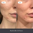 thumbnail image 5 of Mighty Patch by Hero Cosmetics Invisible+ Daytime Acne Pimple & Zit Patch Treatment with Hydrocolloid, 27 Count, 5 of 9