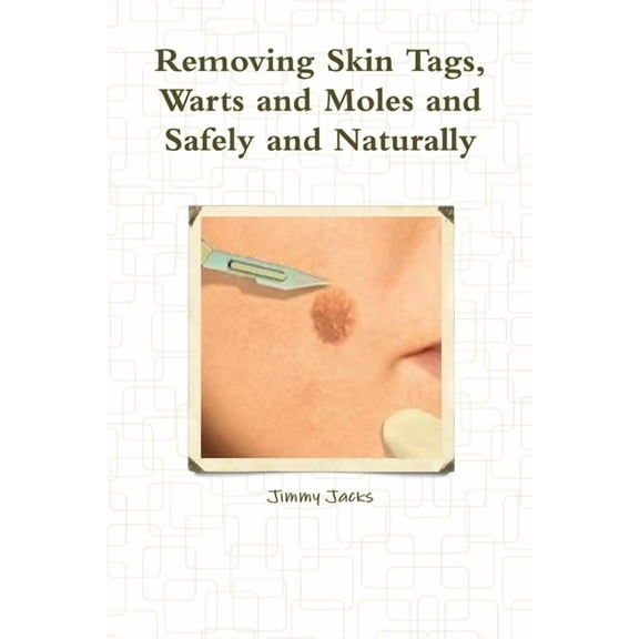 Removing Skin Tags, Warts and Moles and Safely and Naturally, (Paperback)