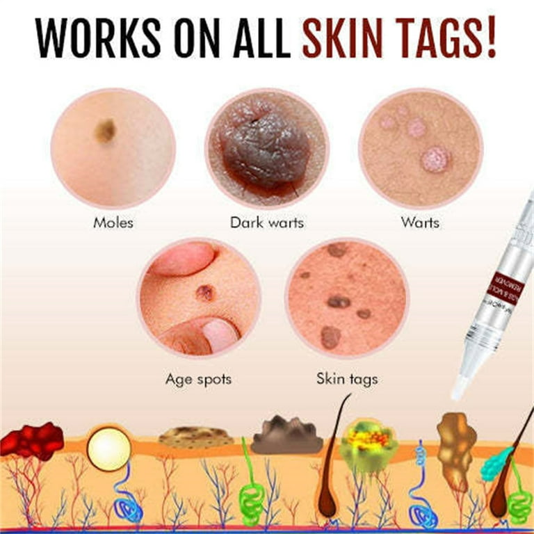 Wipeoff Tags & Moles Remover Pen Quick & Safe Natural Ingredients