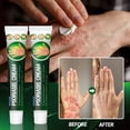 thumbnail image 4 of Herbal Plant Extract Skin Lichen Relief Ointment, Skin Lichen Care for Hands and Feet, Itch Relief - ERAYCEE - 1 Piece, 4 of 5