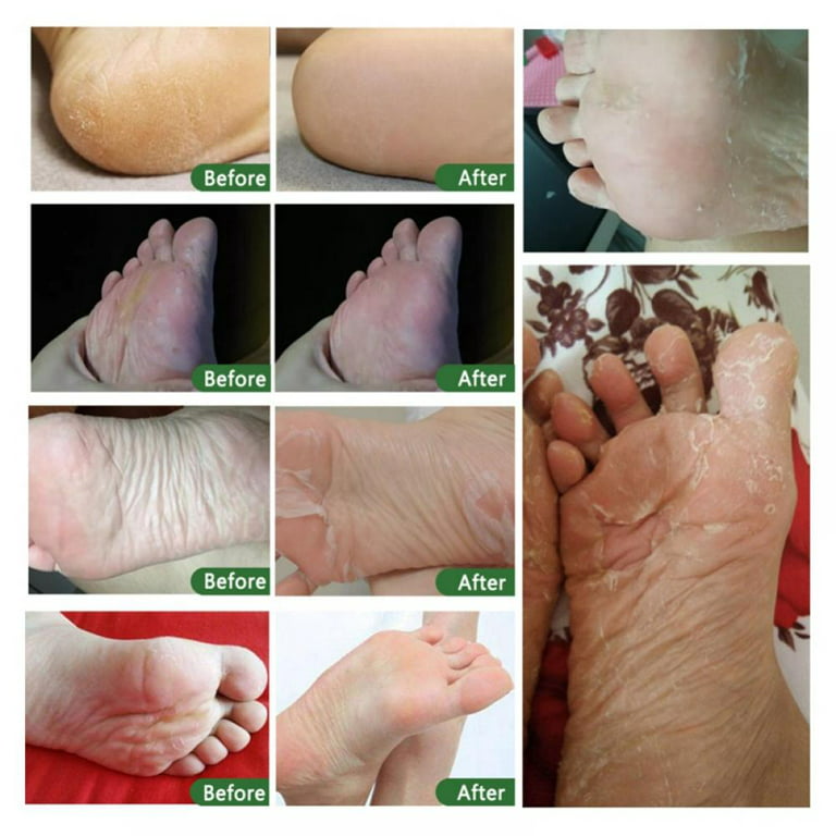Foot Exfoliator Softener Remove Dead Skin Calluses Foot Mask Anti-Cracked  Heel Enhancer Nail Pedicure Elbow Knee Exfoliation