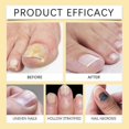 thumbnail image 4 of Bee Venom Fungal Nail Treatment for Toenail Extra Strong, Nail Fungus Solution, Anti Toe Toenail Nail Fungal Solution for Ingrown Toenail Treatment, 4 of 4