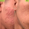 thumbnail image 5 of Kit de cuidado de la piel Acne System SLMD de Dr. Pimple Popper para 30 días y 4 piezas, 5 of 5