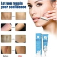 thumbnail image 2 of Belleza para mujeres y eliminación de cicatrices mantiene la cara hidratada y repara la piel dañada Gel para cicatrices 15g, 2 of 5