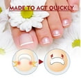 thumbnail image 2 of Tratamiento para uñas encarnadas, corrector de uñas encarnadas, tratamiento para uñas encarnadas, aceite para cutículas, fortalecedor de uñas, 2 of 5