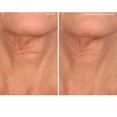 thumbnail image 2 of Parche antiarrugas para el cuello SiO Beauty NeckLift Overnight, 2 of 8