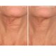 thumbnail image 2 of Parche antiarrugas para el cuello SiO Beauty NeckLift Overnight, 2 of 8