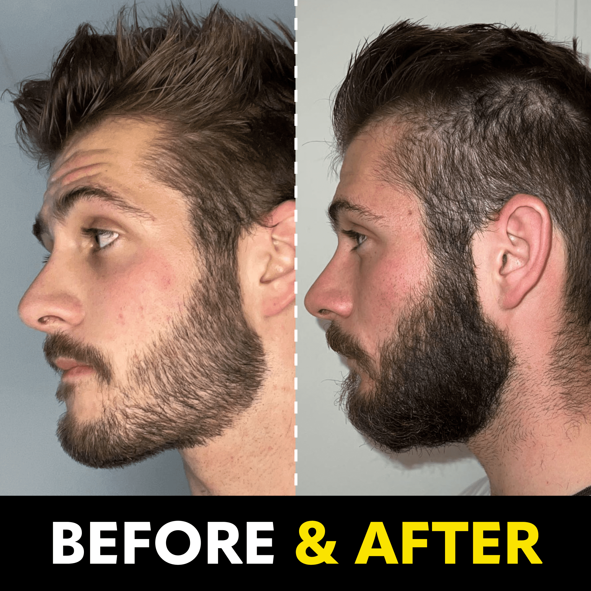 Beard Club Derma Roller for Face, Scalp and Body Care - Microneedling Tool for Men & Women