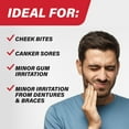 thumbnail image 5 of (2 pack) Orajel 3X Medicated Toothache & Gum Pain Gel, Oral Pain Reliever, Extra Strength, 0.42 oz, 5 of 15