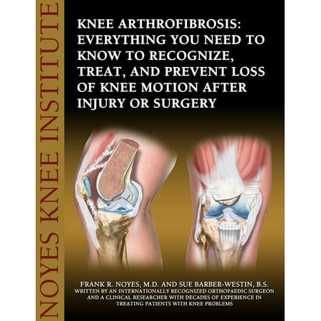 Knee Arthrofibrosis: Everything You Need to Know to Recognize, Treat, and Prevent Loss of Knee Motion After Injury or Surgery -