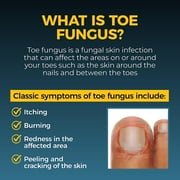 Fungi-Nail Pen Applicator Anti-Fungal Solution, Kills Fungus That Can Lead to Nail & Athlete’s Foot with Tolnaftate & Clinically Proven to Cure and Prevent Fungal Infections | 0.20 Fl Oz (Pack of 2)