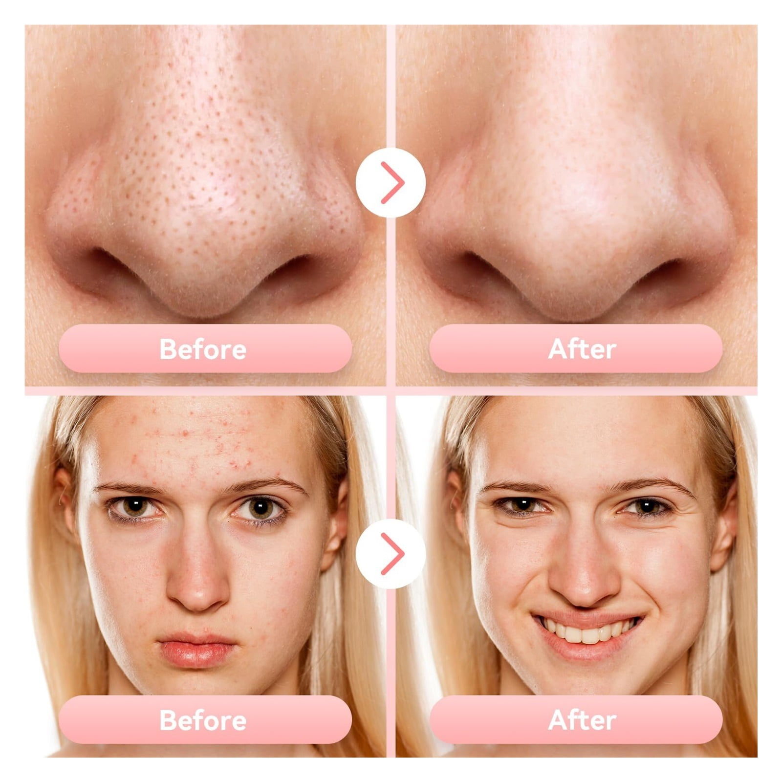 Blackhead Remover Pore Vacuum Upgraded Facial Pore Cleaner Electric Comedone Whitehead Extractor Tool-5 Suction Power,USB Rechargeable Blackhead Vacuum Kit for Women & Men
