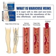 thumbnail image 3 of Varicose Vein Cream 50g Varicose Vein Cream Anti-spider And Vein Removal Varicose Leg Care high quality nice, 3 of 4