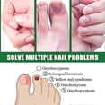 thumbnail image 3 of high qualityFungal Nail Serum for Toenails Extra Strong, Nail Fungus Serum for Toenail, Fungal Nail Treatment Fix Renew Damaged, Broken Nails, Nail St, 3 of 5