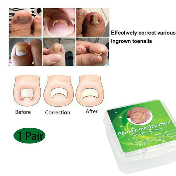 2 piezas de herramienta de corrección de uñas encarnadas BuyWeek protector de uñas de los pies silicona