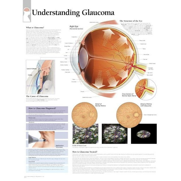 Understanding Glaucoma chart : Wall Chart (Wallchart)
