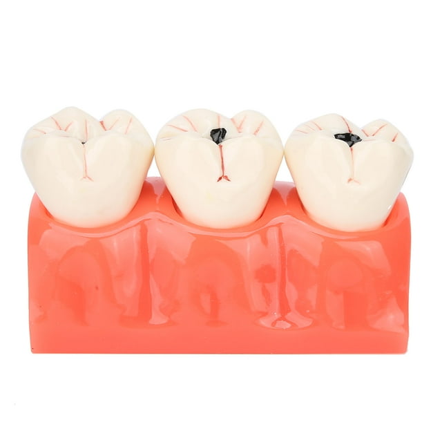 Teeth Caries Model, Simulation Teeth Caries Model Clear Display Excellent Texture Practical And Exquisite For Family For Home