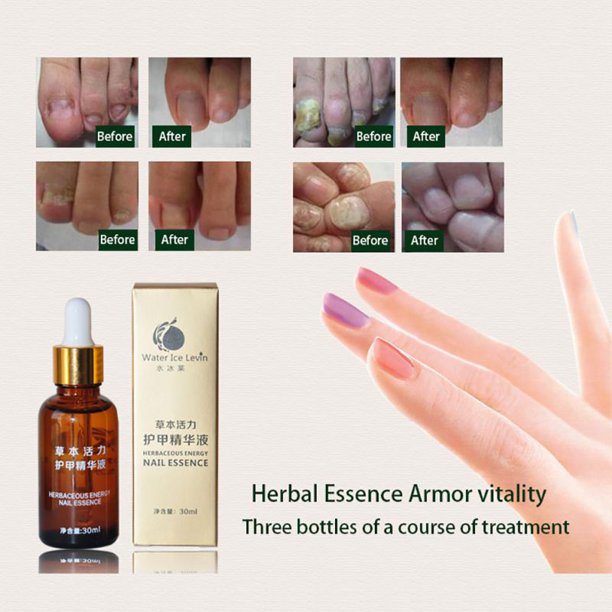Funcee 30ml Finger Toe Care Anti Fungal Nail Treatment Nail Fungus Infection Essence Oil Walmart Com Walmart Com