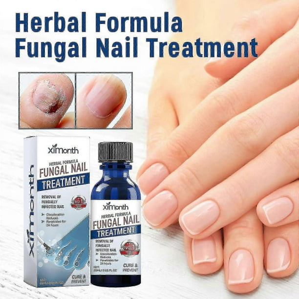 Formula Fungal Nail Paronychia Treatment Gel, Toenail Fungus Treatment, Extra Strength Nail Repair Solution For Finge