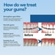 thumbnail image 4 of Gum Therapy Gel-3x4ml Deep Cleaning Tooth Stains, Tartar, Sore Gums, Gum Care Dental Cleansing Gel, 4 of 5