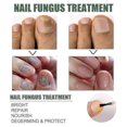 thumbnail image 2 of Traitement Extra Fort des Champignons des Ongles, Meilleur Traitement de Réparation des Ongles pour Arrêter la Croissance Fongique, 2 of 2