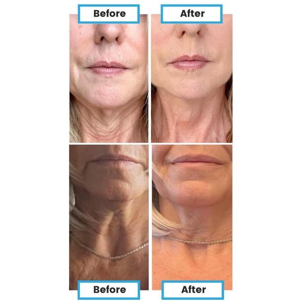 is glutathione whiten skin Amazon.com: Glutathione Whitening Pills - 120 Capsules 2000mg Glutathione -  Effective Skin Lightening Supplement - Dark Spots, Melasma & Acne Scar  Remover, Hyperpigmentation Treatment