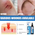 thumbnail image 3 of Scar Repair Treatment Wound Spray Wound Repair, 3 of 4