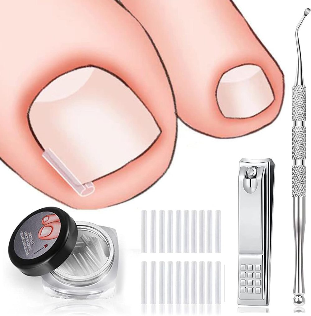 (60+2) Pack Ingrown Toenail Treatment Kit Include 60 Pcs Ingrown