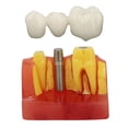thumbnail image 1 of Modelo De Implante Dental, Resina De Modelo De Dientes De Implante Seguro Para Educación, 1 of 7
