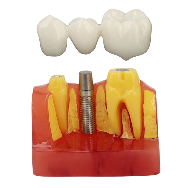 Modelo De Implante Dental, Resina De Modelo De Dientes De Implante Seguro Para Educación